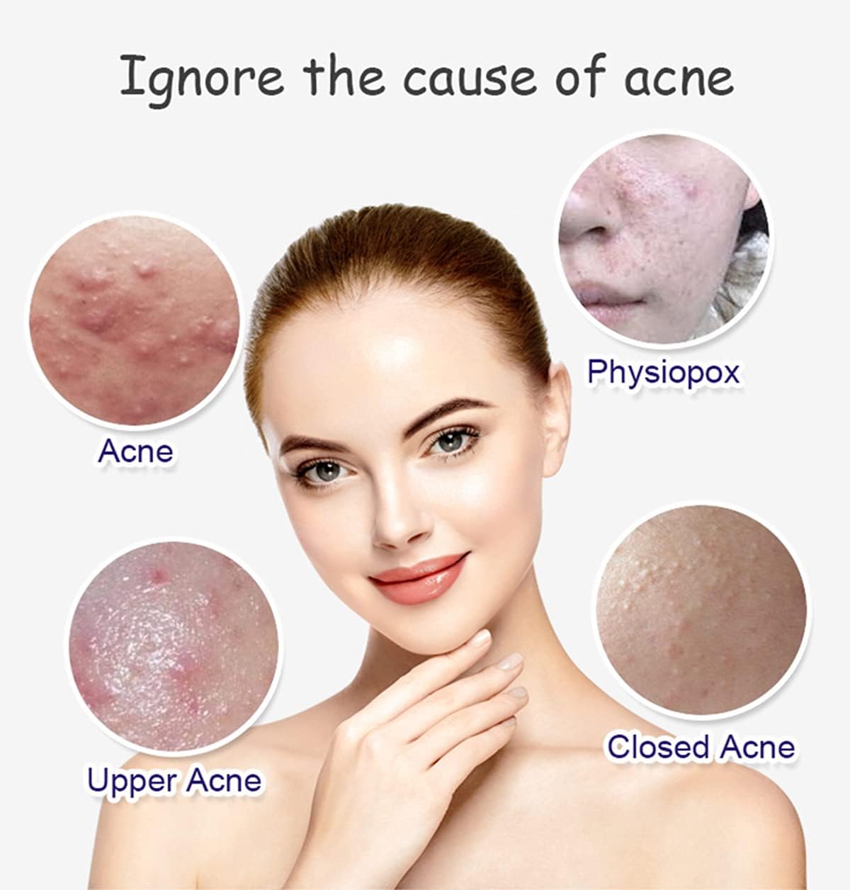 Aichun Beauty Anti - Acne Whitening Facial Serum Aloe Vera Extract Salicylic Acid Repairs Damaged Skin | 30ml